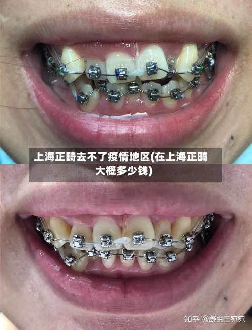 上海正畸去不了疫情地区(在上海正畸大概多少钱)-第2张图片